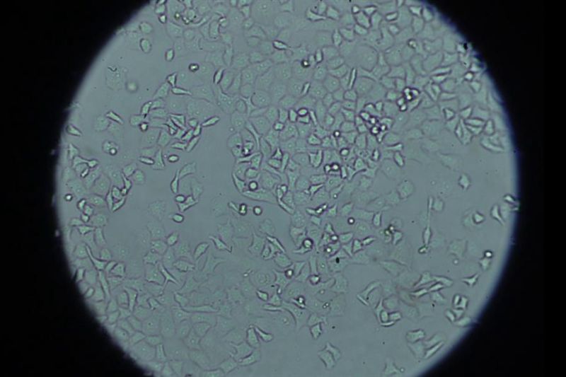 Una imagen al microscopio de las células tumorales de cáncer de páncreas. EFE/Crédito: Imagen cedida por el Hospital 12 de Octubre.