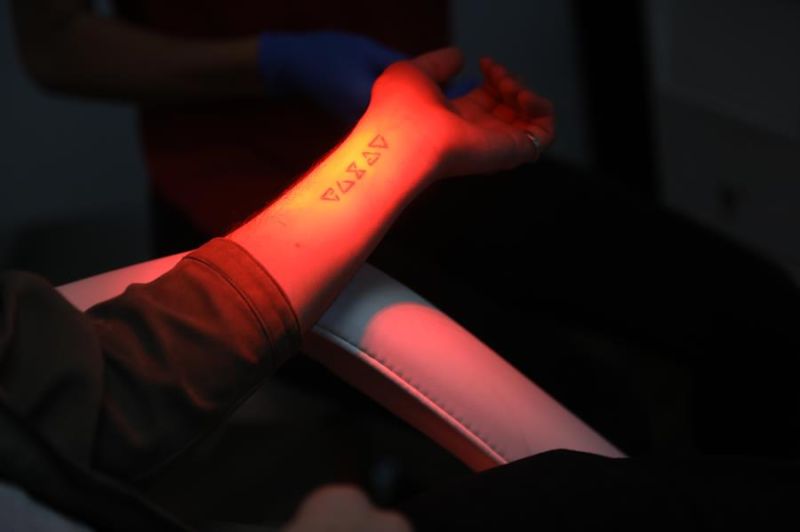 Detalle de un tatuaje borrado el 12 de febrero del 2021 en la clínica MissInk, en Ciudad de México (México).